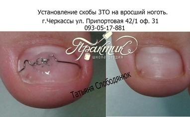 Nail-Практик - Лікування врослих нігтів - фото 1