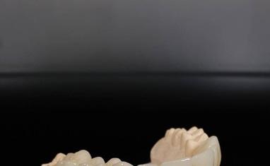 Стомадеус - Протезирование зубов – возможность вернуться к полноценной жизни - фото 3