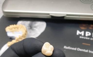 Стомадеус - Протезування зубів – можливість повернутися до повноцінного життя - фото 4
