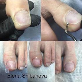 Фото 1 - Коррекция (лечение) вросшего ногтя