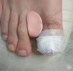 Фото 2 - Коррекция (лечение) вросшего ногтя