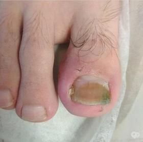 Фото 3 - Коррекция (лечение) вросшего ногтя