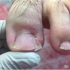 Фото 4 - Коррекция (лечение) вросшего ногтя