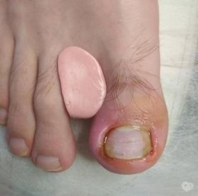 Фото 5 - Коррекция (лечение) вросшего ногтя