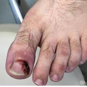 Фото 7 - Коррекция (лечение) вросшего ногтя