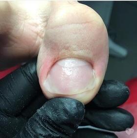 Фото 6 - Коррекция (лечение) вросшего ногтя