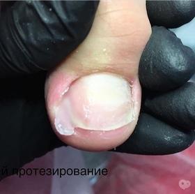 Фото 8 - Коррекция (лечение) вросшего ногтя