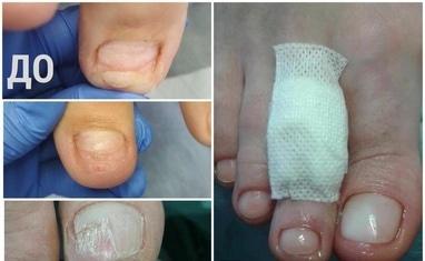 Здорові стопи - Протезування нігтів - фото 1