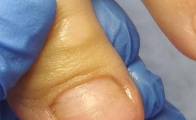 Здорові стопи - Протезування нігтів - фото 2