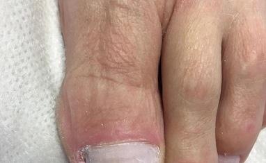 Здорові стопи - Протезування нігтів - фото 3
