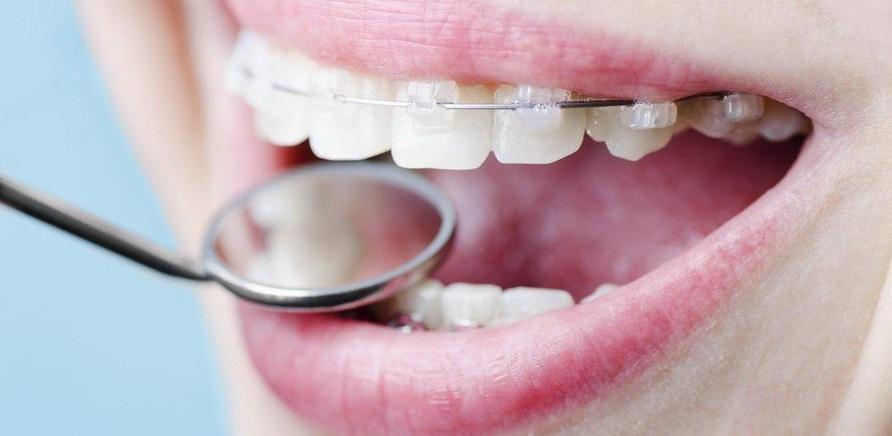 '8 вопросов о брекетах к стоматологу'