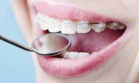 Статья '8 вопросов о брекетах к стоматологу'