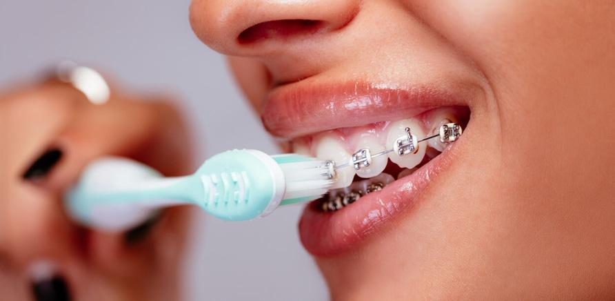 8 вопросов о брекеты к стоматологу