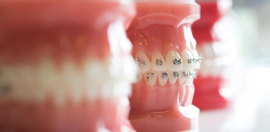 8 запитань про брекети до стоматолога