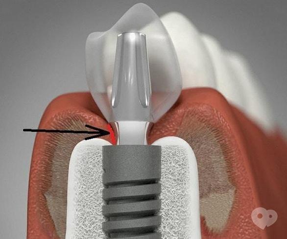 Стоматологія Соболевського - Імплантація зубів в питаннях і відповідях. Етап протезування