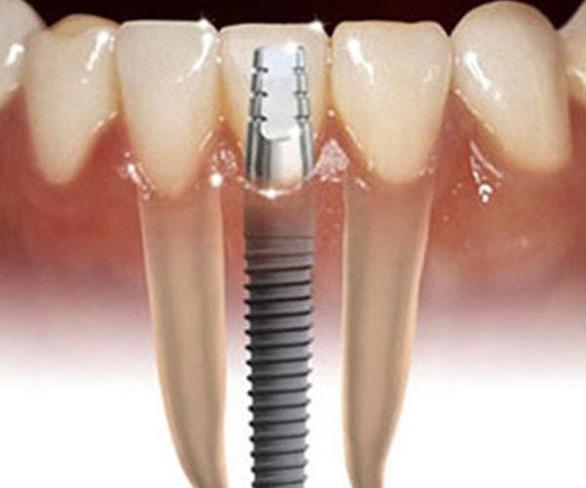 Стоматологія Соболевського - Імплантація зубів в питаннях і відповідях. Тим, хто ще не визначився присвячується... Частина 1
