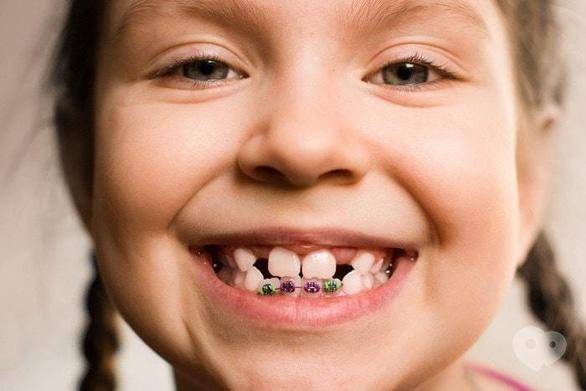 Сучасна Сімейна Стоматологія - Неправильний прикус у дітей: причини й лікування