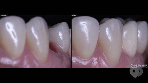 Центр стоматологии Голобородько - Может ли выглядеть зуб на импланте, как свой?