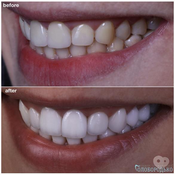 Центр стоматології Голобородько - Яким чином можна 'освіжити' або зробити  яскраву посмішку?