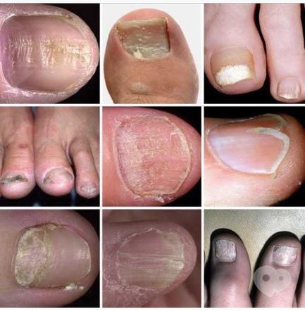 Здоровые стопы - Что такое дистрофия ногтя