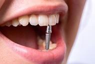 Фільм'Імплантація зубів – підвищення якості життя!!' - фото 1