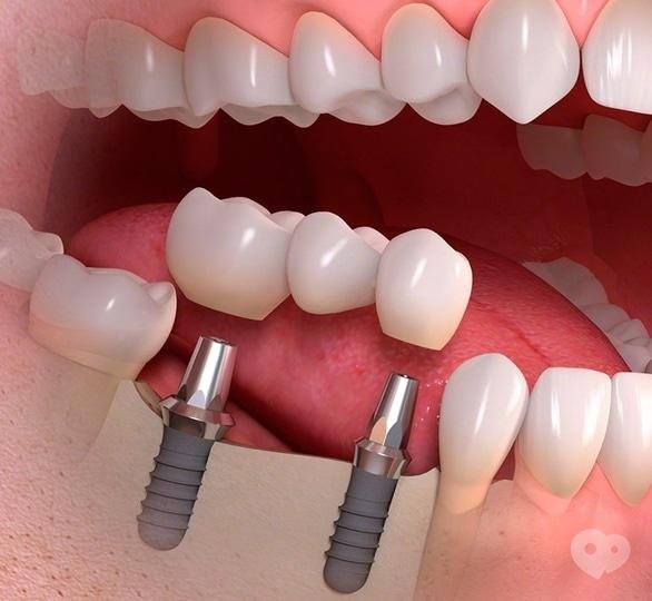 Стомадеус - Імплантація зубів – підвищення якості життя!!