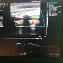 Фильм'УЗИ сосудов головы и шеи (дуплексное сканирование брахиоцефальных артерий, транскраниальное дуплексное сканирование)' - фото 2