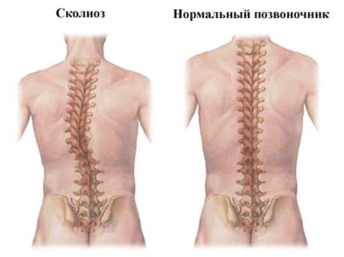 Опасные симптомы заболеваний позвоночника - Клиника Современной Неврологии «Аксимед»