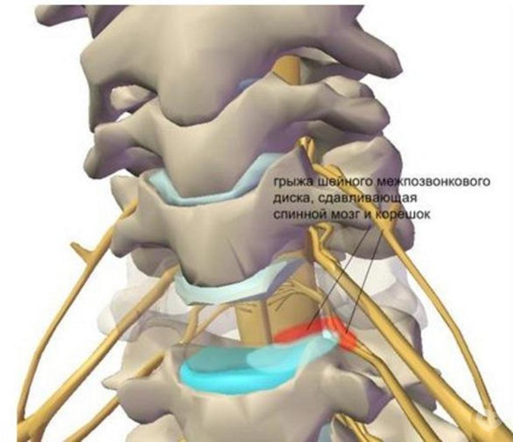 Остеохондроз шейный нерв. Грыжа межпозвонкового диска в шейном отделе. Радикулопатия c6. Грыжа сдавливание спинного мозга и нервных Корешков,. L5 s1протрузия иннервация.