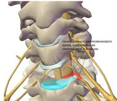Вільний рух, медицинский центр - Лечение синдрома позвоночной артерии (головокружение и частые головные боли)