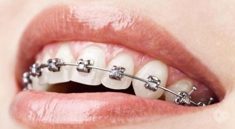Багіта, стоматологічна клініка - Виправлення прикусу