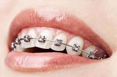 Багіта, стоматологічна клініка - Виправлення прикусу