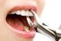 Стоматологія Соболевського - Видалення зуба (багатокореневого)