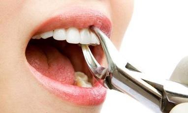 Стоматология Соболевского - Удаление зуба (многокорневой)