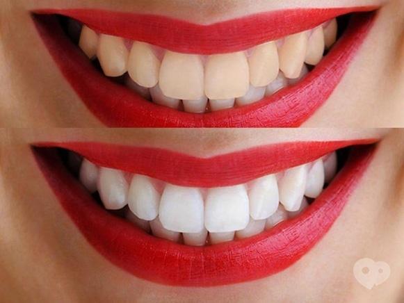 Сучасна Сімейна Стоматологія - Еко відбілювання зубів
