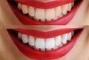 Сучасна Сімейна Стоматологія - Эко отбеливание зубов