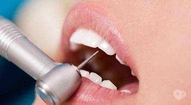 Smileup, стоматологія - Пломба ESTELITE SIGMA QUICK