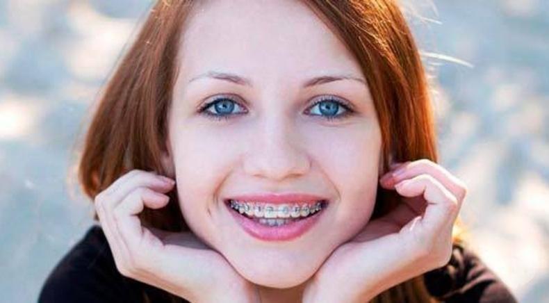 Smileup, стоматологія - Металева брекет-система 1 щелепа