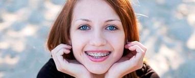 Smileup, стоматология - Металлическая брекет-система 1 челюсть