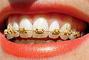 Smileup, стоматология - Золотая брекет-система одна челюсть