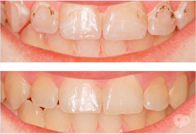 Smileup, стоматология - ICON лечение кариеса без бора
