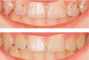 Smileup, стоматологія - ICON лікування карієсу без бору