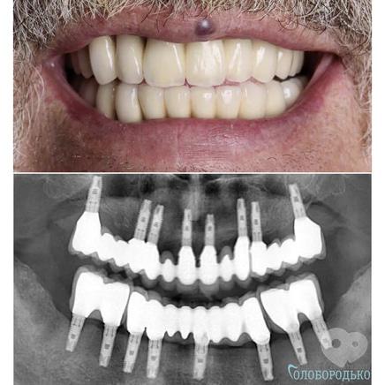 Центр стоматології Голобородько - Тотальне протезування Центр стоматології Голобородько - Тотальне протезування