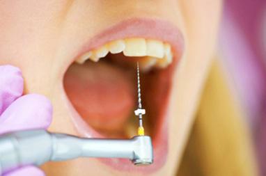 Сучасна Сімейна Стоматологія - Лікування каналів