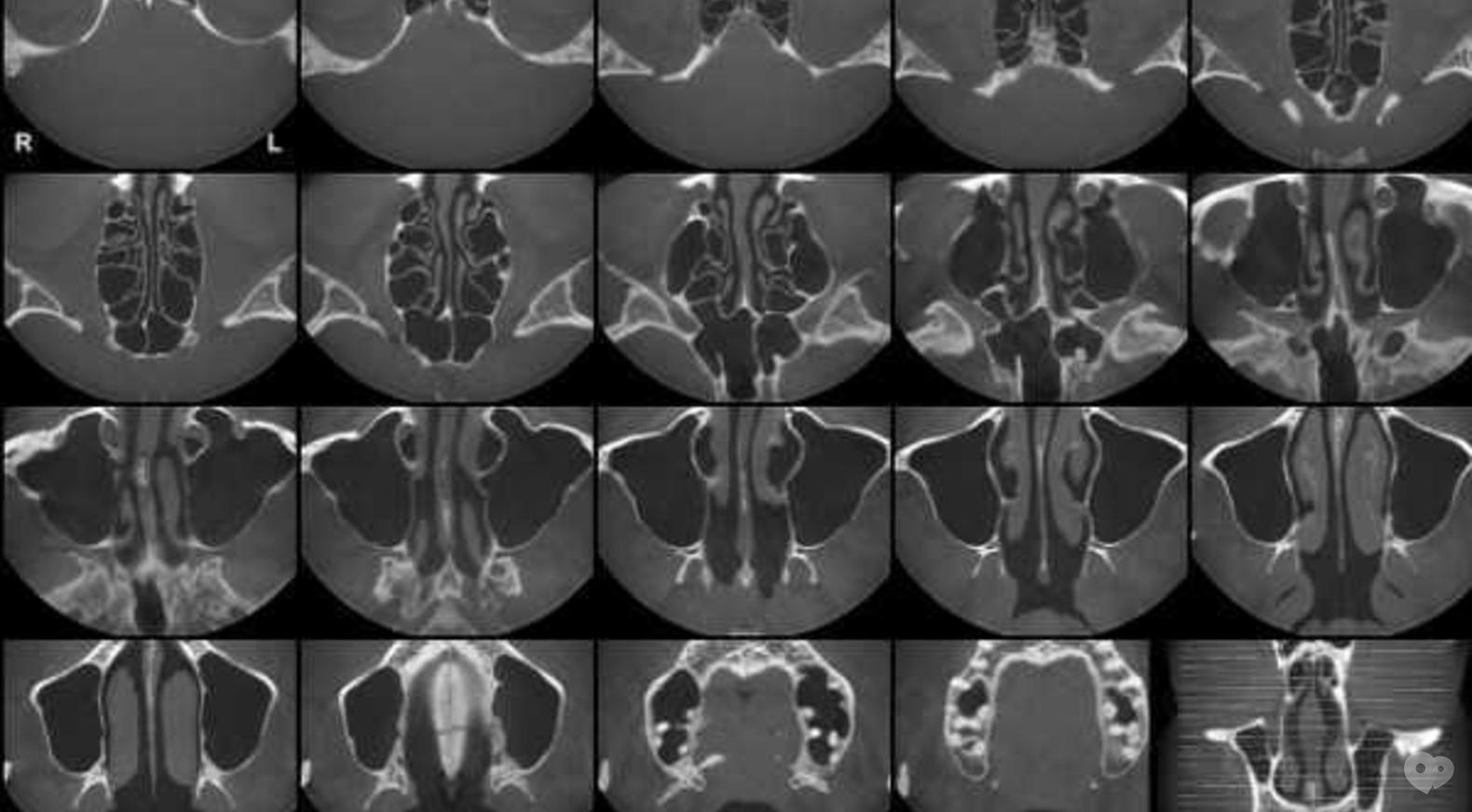Сделать кт носа. 3д кт околоносовых пазух. Кт околоносовых пазух аппарат. Кт придаточных пазух носа. Компьютерной томографии (кт) околоносовых пазух.
