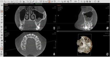 EcoSvit, кабинет диагностики - Компьютерная томография одной челюсти (верхней или нижней)