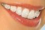 Smileup, стоматологія - Сапфірова брекет система повний супровід