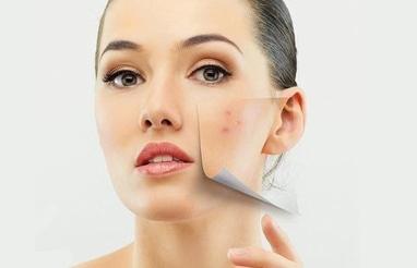 My SeCreT, LPG масаж, лазерна епіляція - Лазерне лікування акне на обличчі