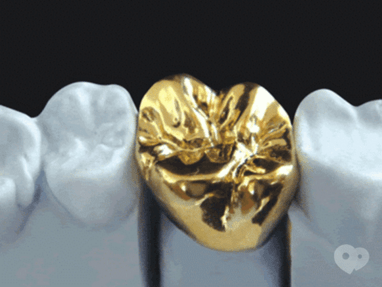 Стомадеус, стоматологическая клиника - Цельнолитая коронка