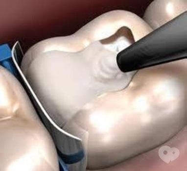 Стомадеус, стоматологічна клініка - Тимчасова пломба